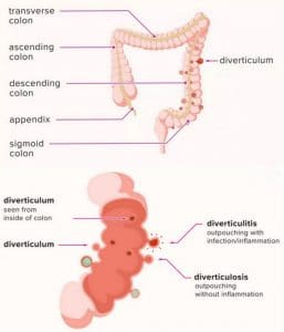 Diverticulitis - Medsana Medical Clinic